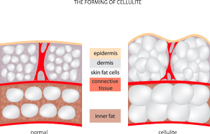 Formazione della cellulite
